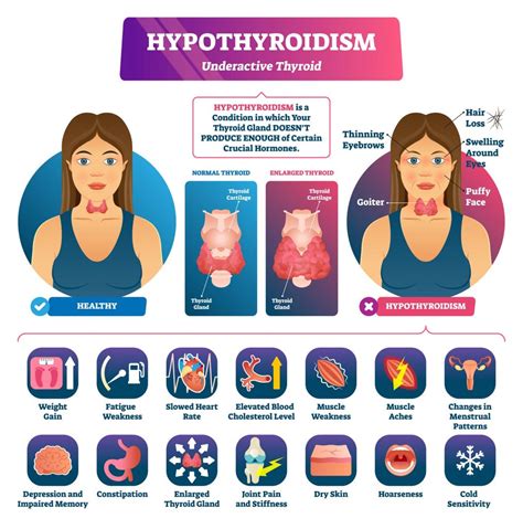 Hypothyroidism  Creating Metabolism Problems